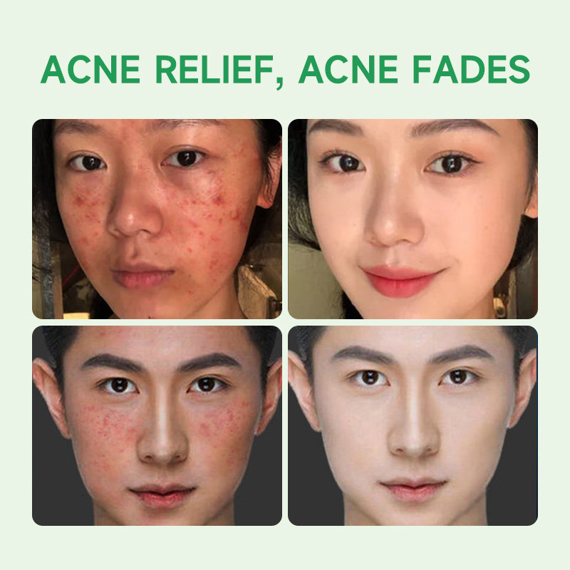 GMEELAN Gel Tea Tree Acne Treatment Essence 20g